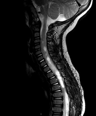 Surgical approaches to intramedullary spinal cord astrocytomas in the age of genomics